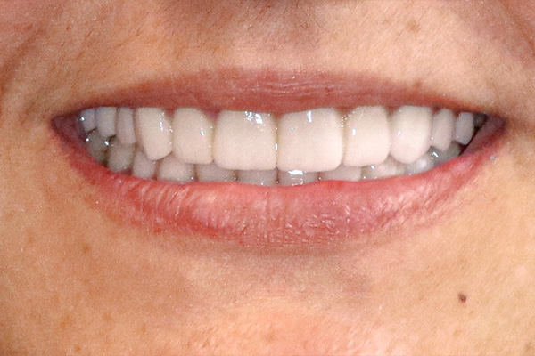 Smile Village Dental Care | Snoring Appliances, Invisalign reg  and Oral Exams