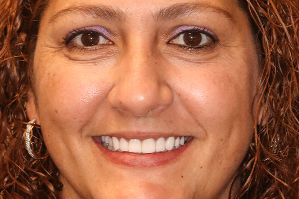 Smile Village Dental Care | Extractions, Dental Bridges and KöR® Teeth Whitening System