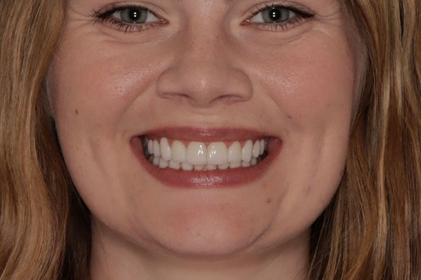 Smile Village Dental Care | Smile Makeover, Snoring Appliances and Dental Bridges