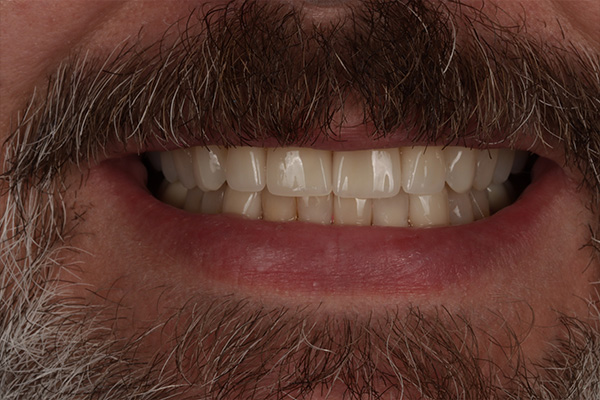 Smile Village Dental Care | Veneers, Dental Bridges and Emergency Treatment