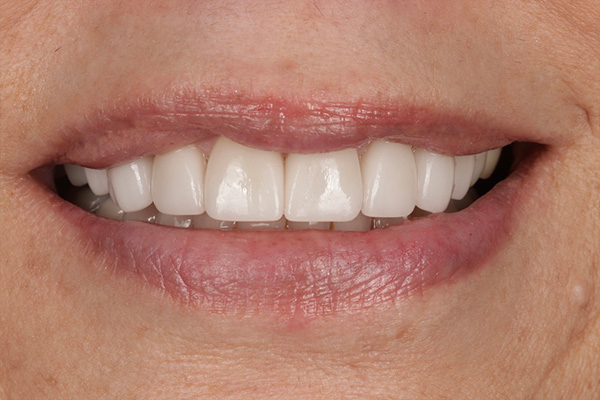 Smile Village Dental Care | Periodontal Treatment, Invisalign reg  and Ceramic Crowns