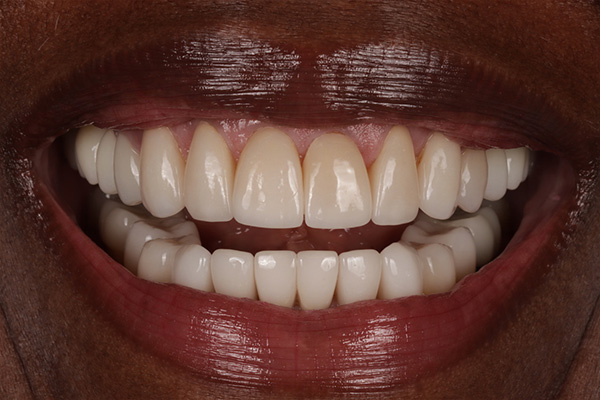 Smile Village Dental Care | Cosmetic Dentistry, Ceramic Crowns and Dentures