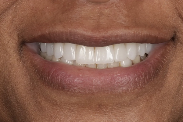 Smile Village Dental Care | K  R reg Teeth Whitening System, Periodontal Treatment and Snoring Appliances