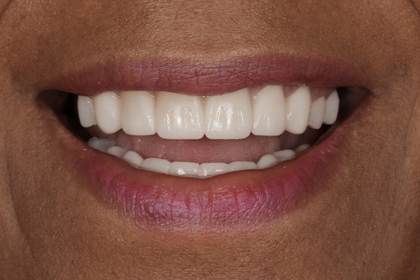 Smile Village Dental Care | Night Guards, Dental Fillings and Dental Bridges