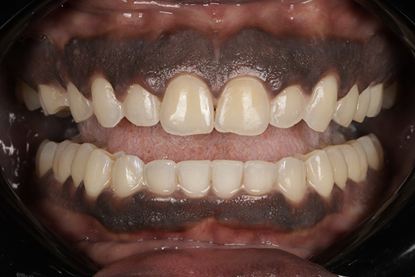 Smile Village Dental Care | K  R reg Teeth Whitening System, All-on-4 reg  and Smile Makeover