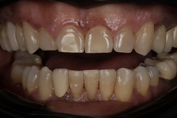 Smile Village Dental Care | Snoring Appliances, ZOOM  Whitening and Ceramic Crowns