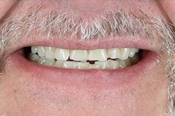 Smile Village Dental Care | All-on-4®, Ceramic Crowns and Implant Dentistry