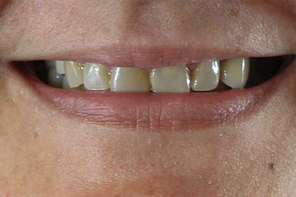 Smile Village Dental Care | Sedation Dentistry, Dental Fillings and Veneers