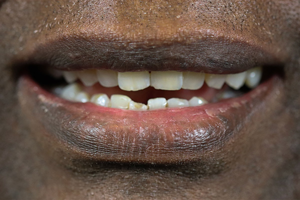 Smile Village Dental Care | Invisalign reg , Emergency Treatment and Veneers