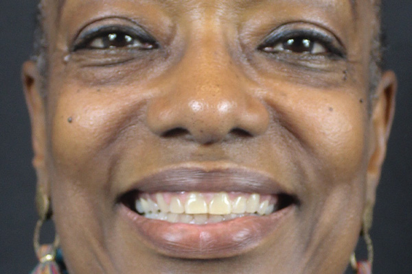 Smile Village Dental Care | Veneers, KöR® Teeth Whitening System and Emergency Treatment