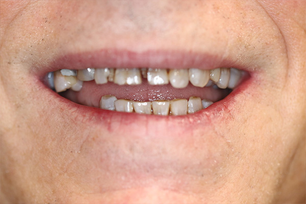 Smile Village Dental Care | Cosmetic Dentistry, Preventative Program and Dental Bridges