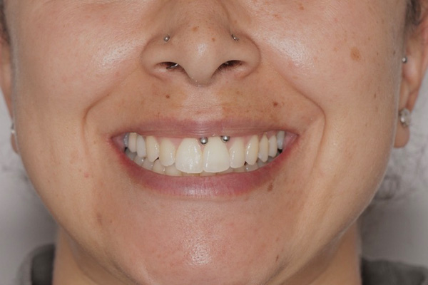 Smile Village Dental Care | Sedation Dentistry, Ceramic Crowns and Snoring Appliances