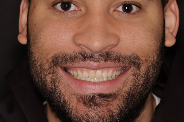 Smile Village Dental Care | Night Guards, Dental Bridges and Dental Fillings