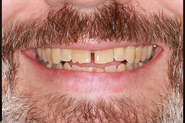 Smile Village Dental Care | All-on-4 reg , K  R reg Teeth Whitening System and Implant Dentistry