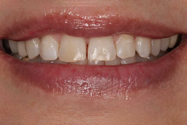 Smile Village Dental Care | Dental Bridges, Sleep Apnea and Dental Fillings