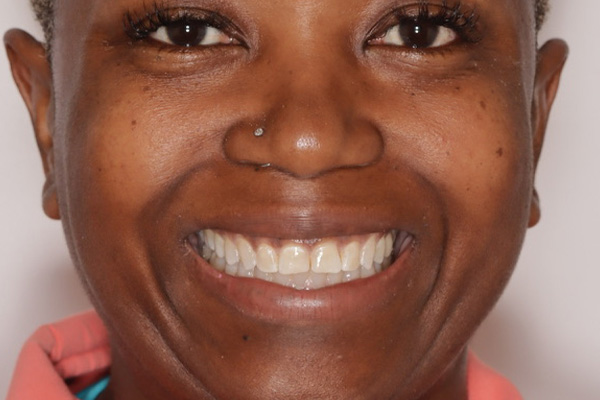 Smile Village Dental Care | Veneers, Sleep Apnea and Implant Dentistry