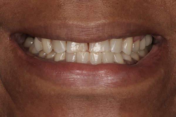 Smile Village Dental Care | K  R reg Teeth Whitening System, Sedation Dentistry and Ceramic Crowns