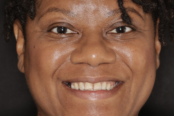 Smile Village Dental Care | Emergency Treatment, K  R reg Teeth Whitening System and Veneers