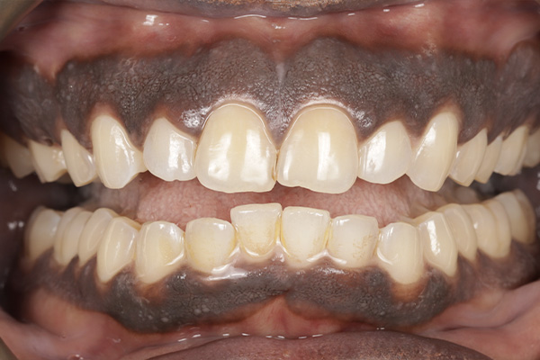 Smile Village Dental Care | Sleep Apnea, Ceramic Crowns and ZOOM  Whitening