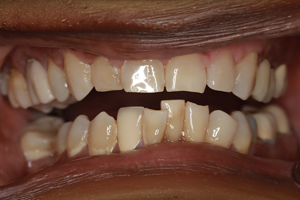 Smile Village Dental Care | Snoring Appliances, Sleep Apnea and Implant Dentistry