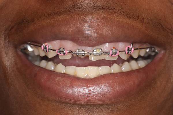 Emergency Dentist Pearland