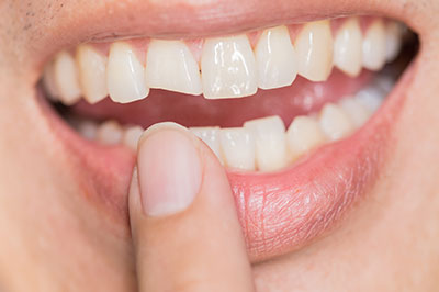 Smile Village Dental Care | Ceramic Crowns, Veneers and Sleep Apnea